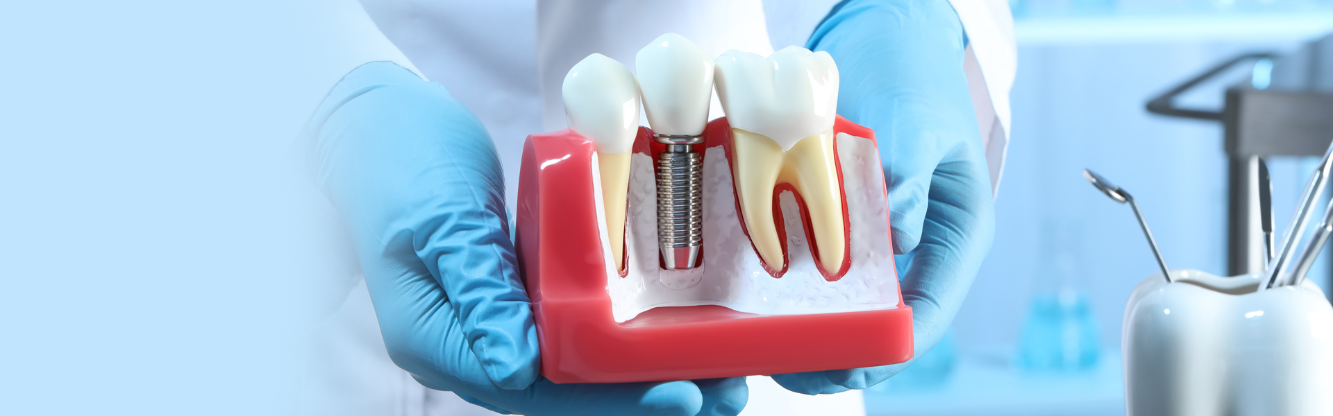 How Do You Care for Your Dental Implants?