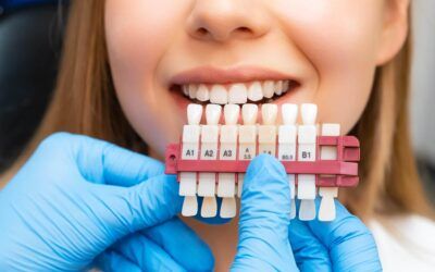 Composite Veneers vs. Porcelain Veneers: What’s the Difference?