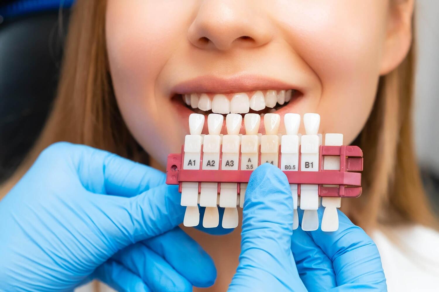 Composite Veneers vs. Porcelain Veneers: What’s the Difference?