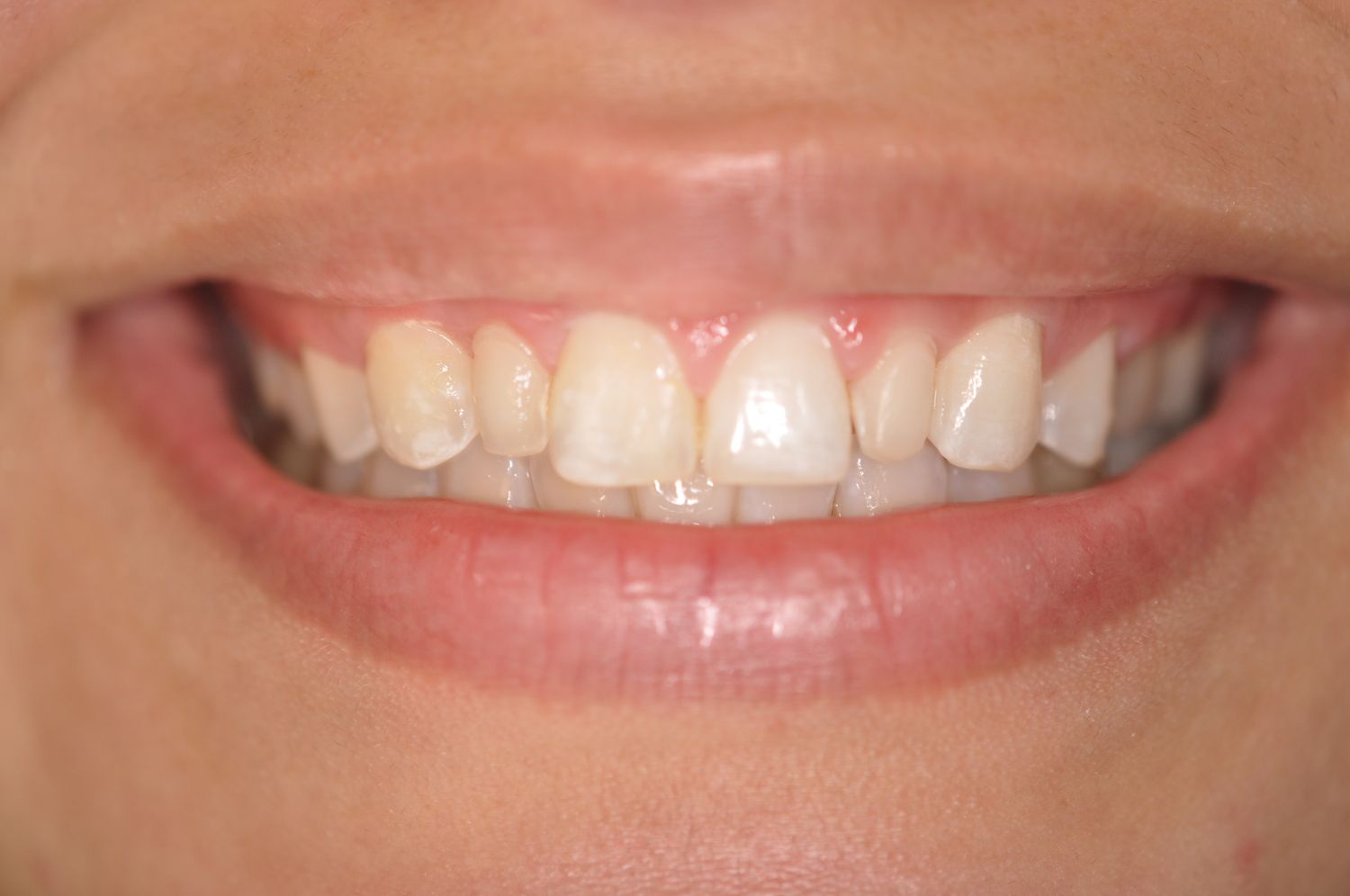 Smile before veneers