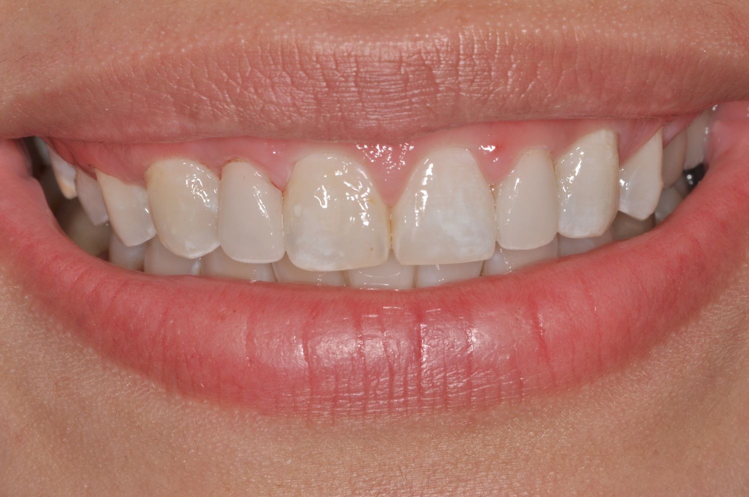 Smile after veneers
