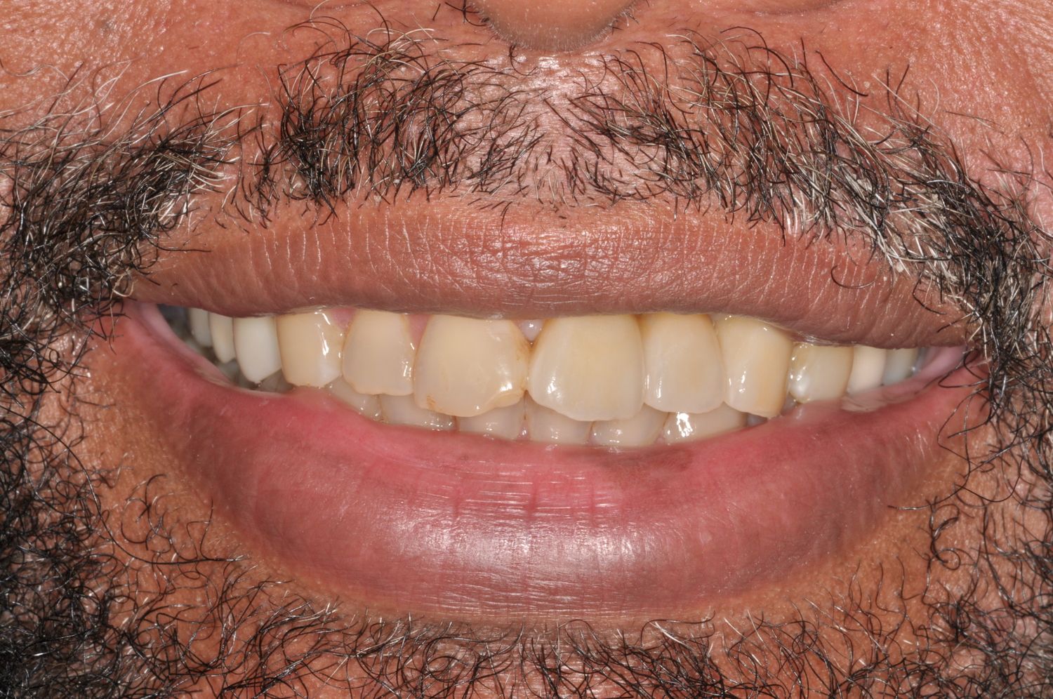 Smile after dental implant treatment