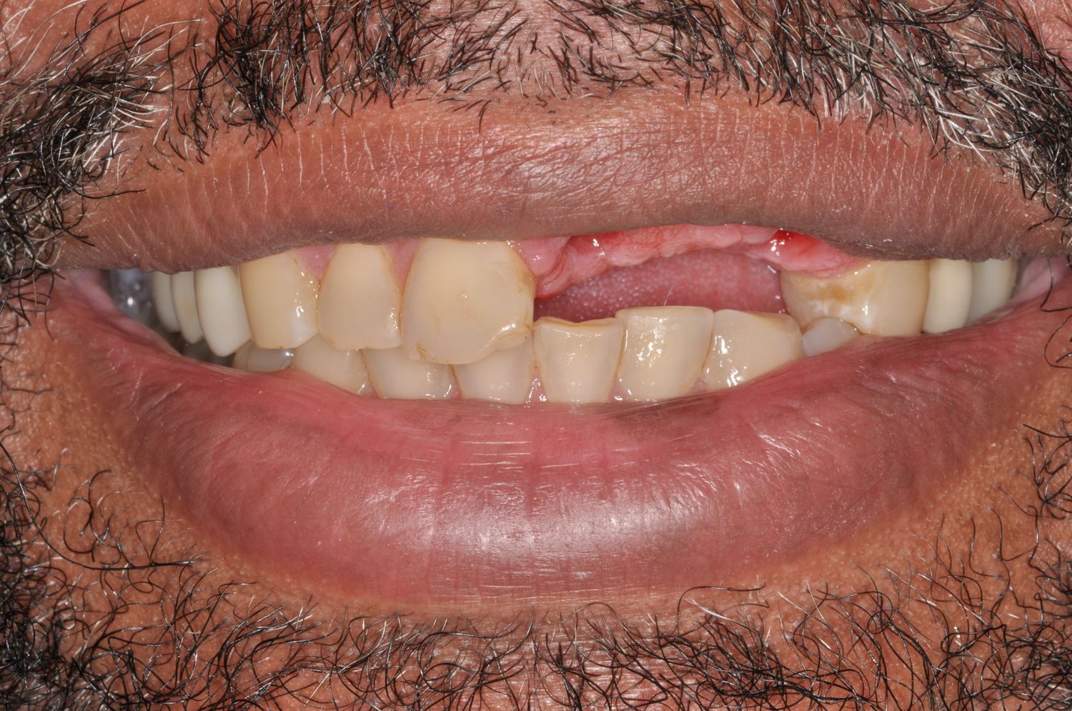 Smile before dental implant treatment